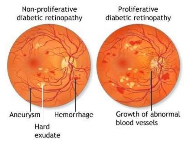 NPDR and PDR treatment in Pune, India