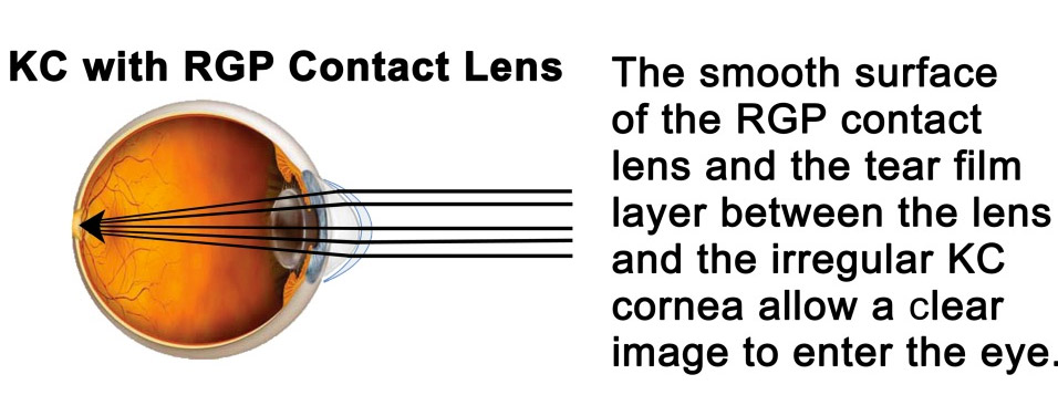 keratoconus with RGPcontact lens