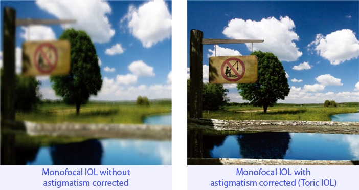 Monofocal IOL with astigmatism corrected (Toric IOL)